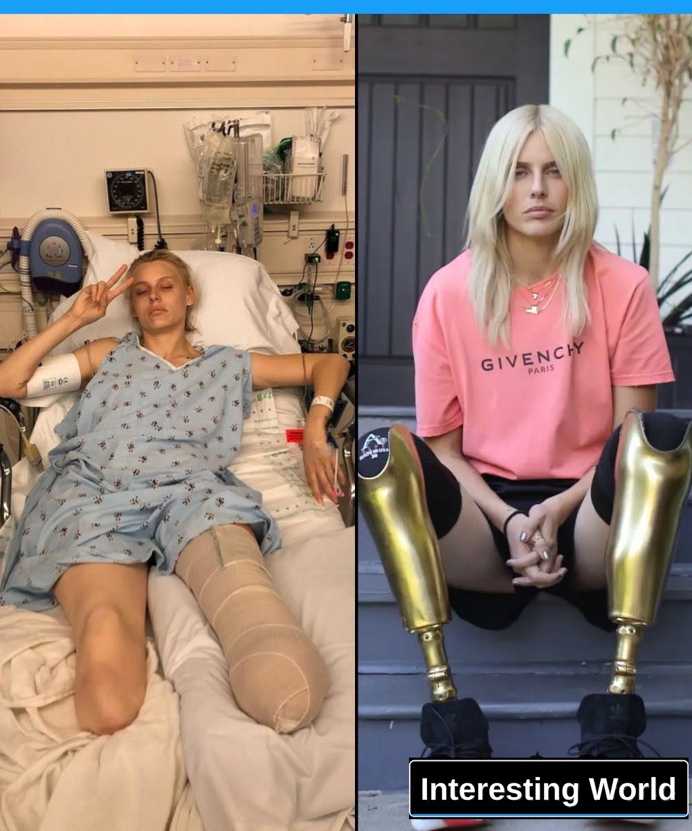 When Lauren Wasser woke up from the coma, there were two words on his legs. On one they wrote: “Yes.” On the other: “No”