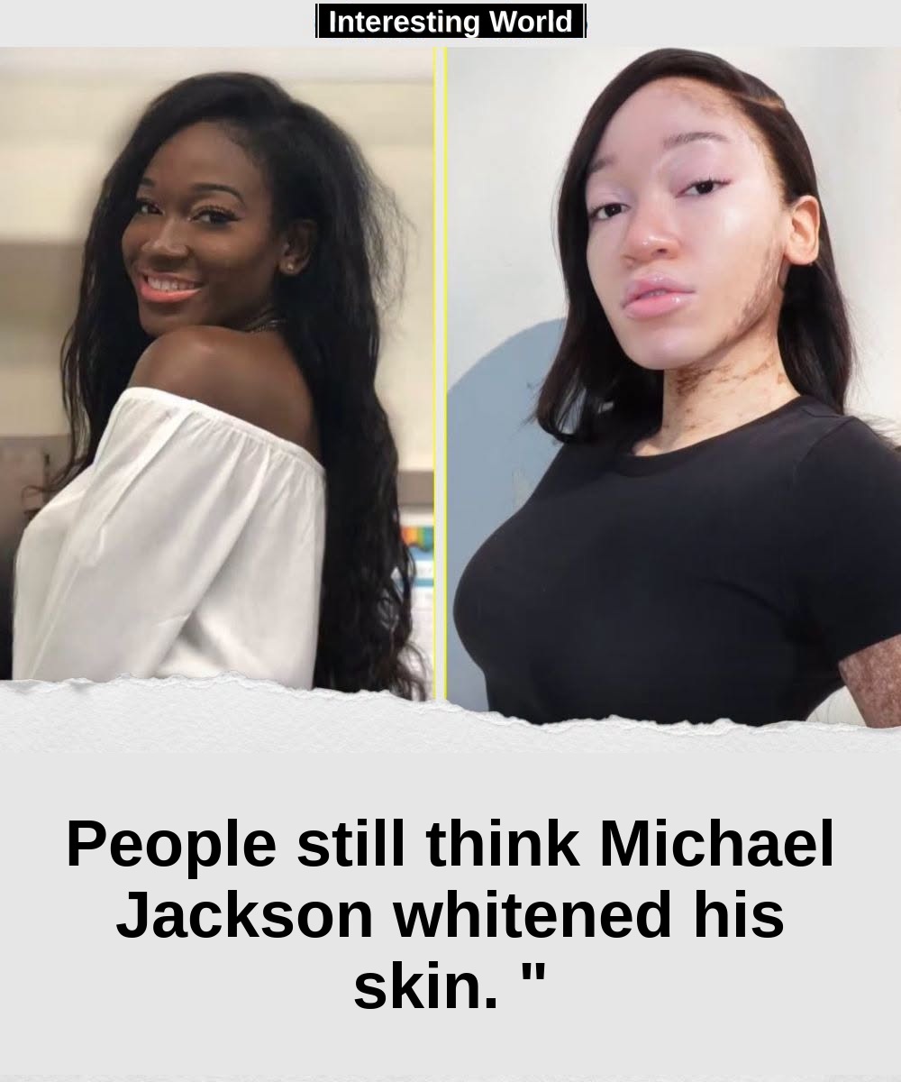 Michael Jackson's skin change has been accompanied by suppositions for years. Today a woman who lives with the same cond